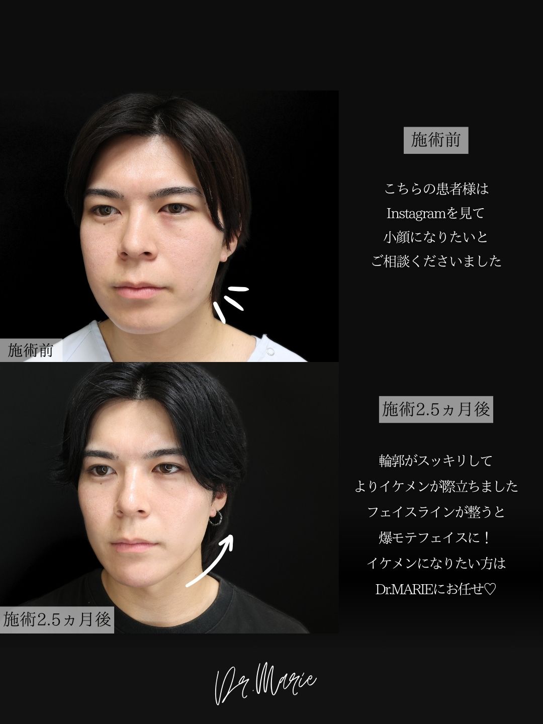 TAC式 ツヤ肌コラーゲンリフト®/Lラインファット除去（エラ下脂肪除去）/ジョールファット除去の症例写真 施術前後 