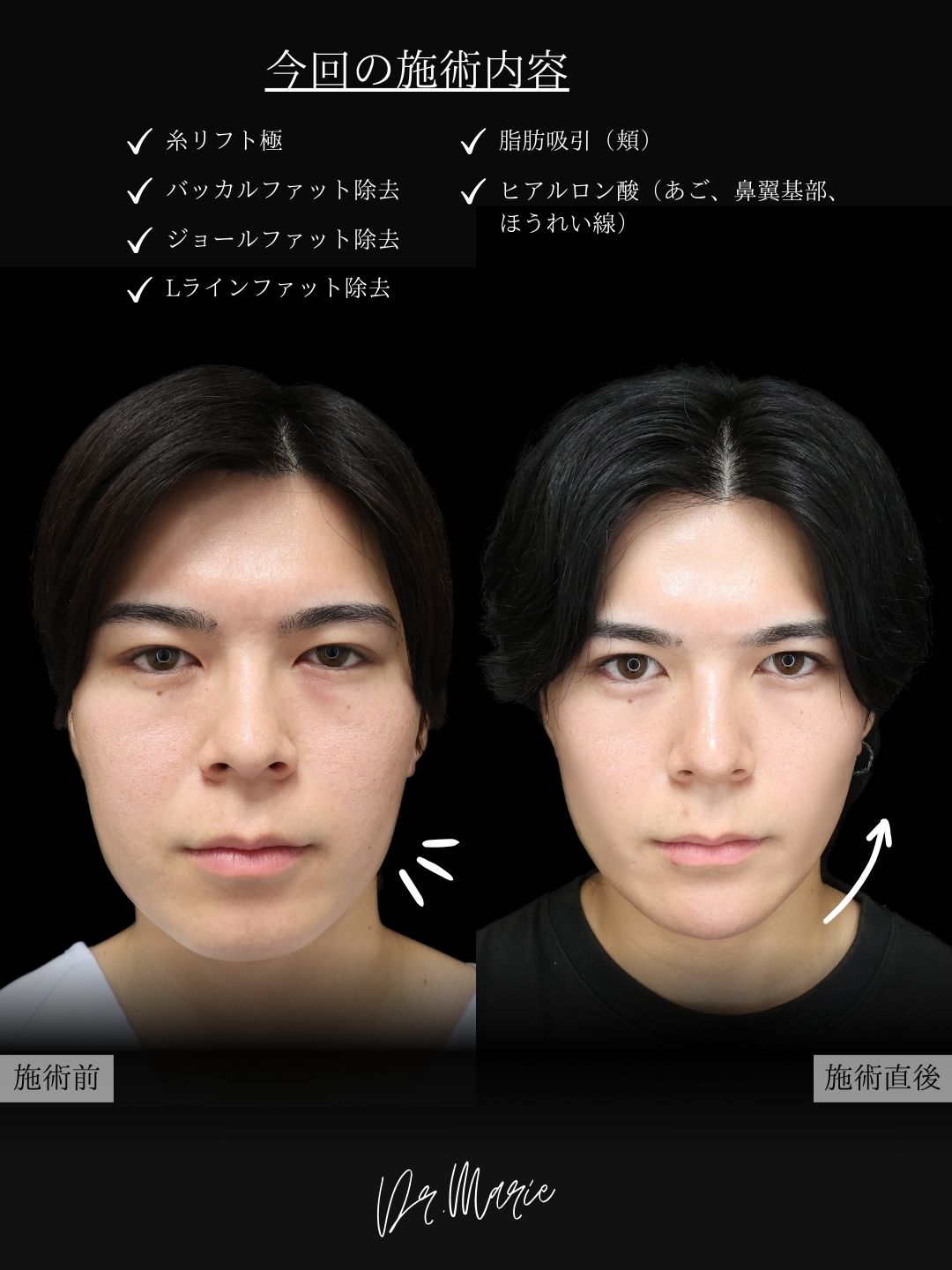 TAC式 ツヤ肌コラーゲンリフト®/Lラインファット除去（エラ下脂肪除去）/ジョールファット除去の症例写真 施術前後 
