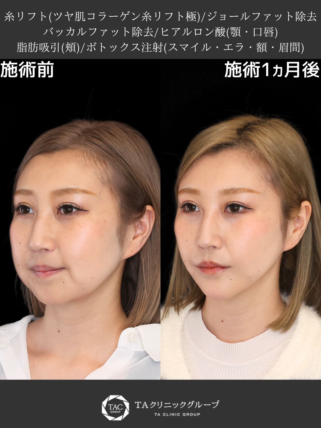 【銀座院院長Dr.Marie】たるみと老け顔改善！脂肪除去＆糸リフトで若返りフェイスへ