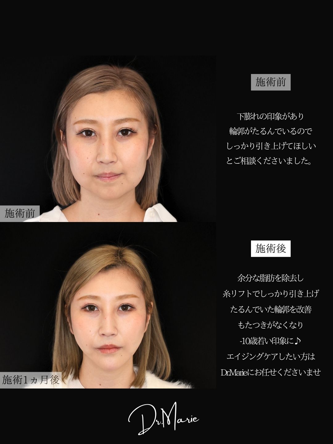 TAC式 ツヤ肌コラーゲンリフト®/ジョールファット除去/バッカルファット除去の症例写真 施術前後 