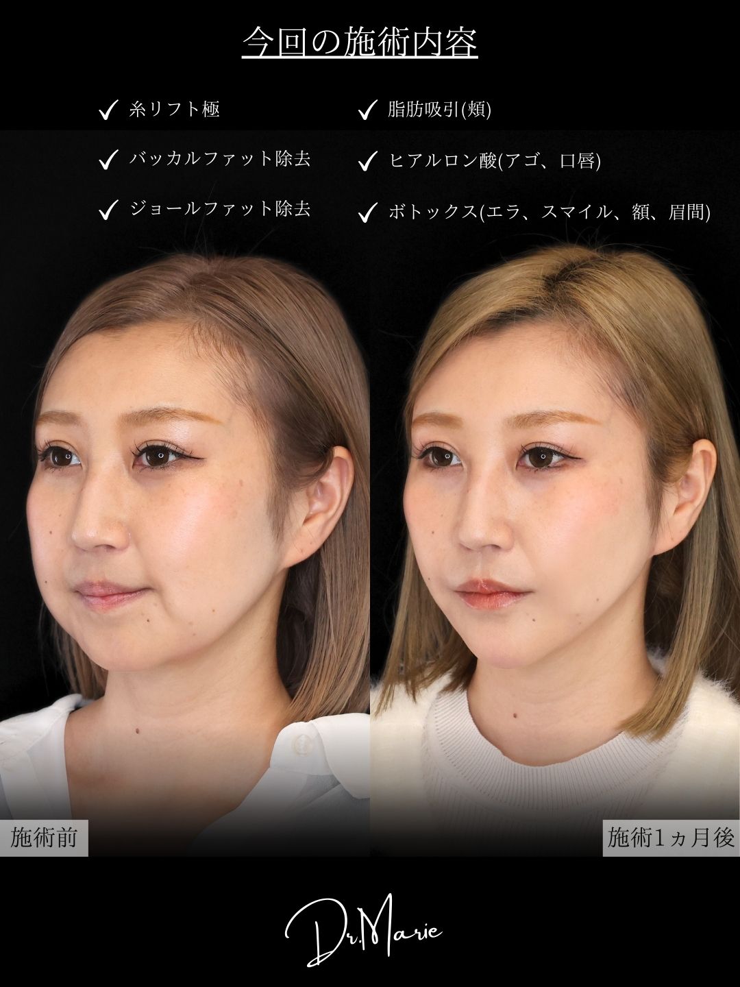 TAC式 ツヤ肌コラーゲンリフト®/ジョールファット除去/バッカルファット除去の症例写真 施術前後 