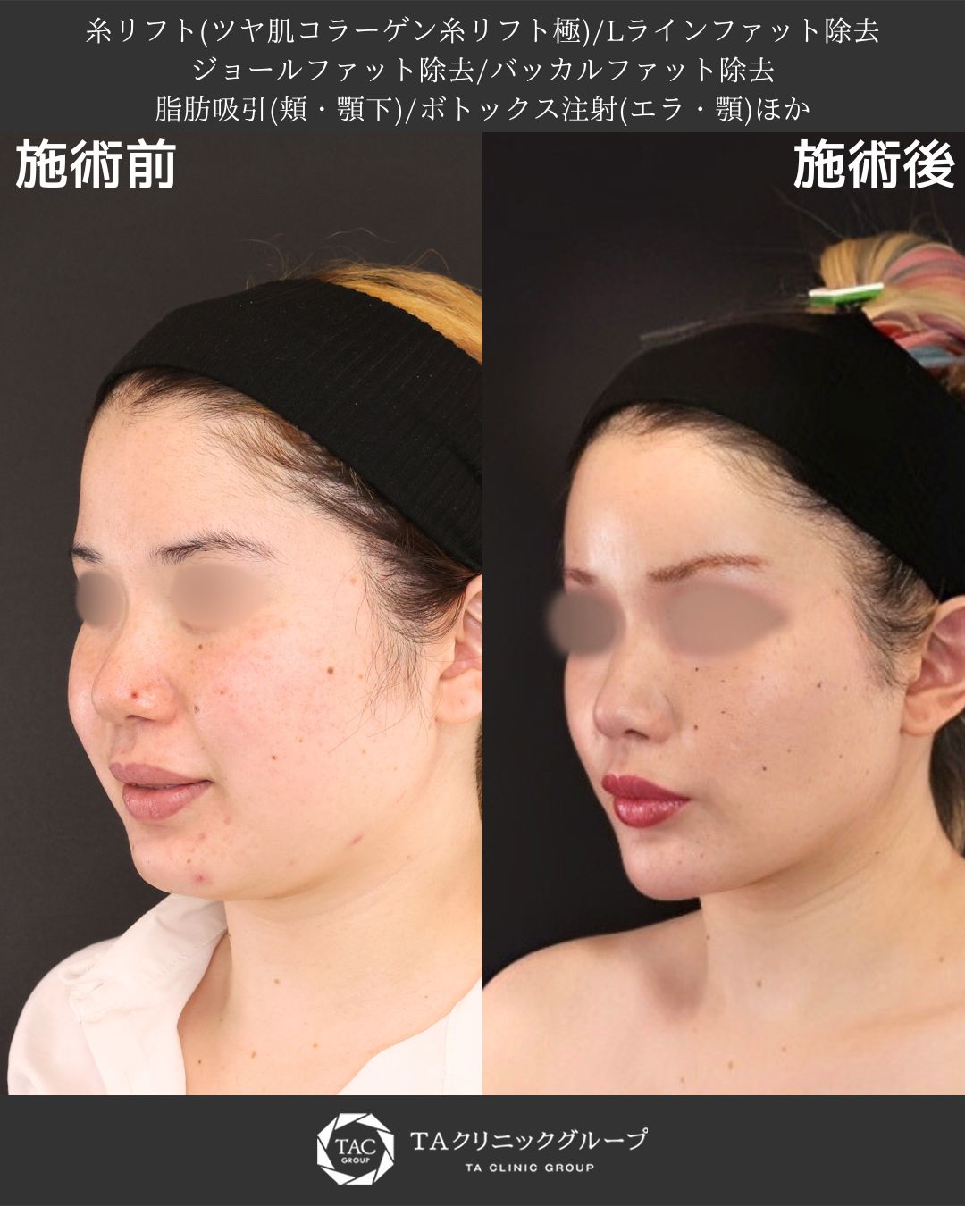 【山田真里江院長執刀】おでこからフェイスライン徹底改善オーダーメイド小顔術