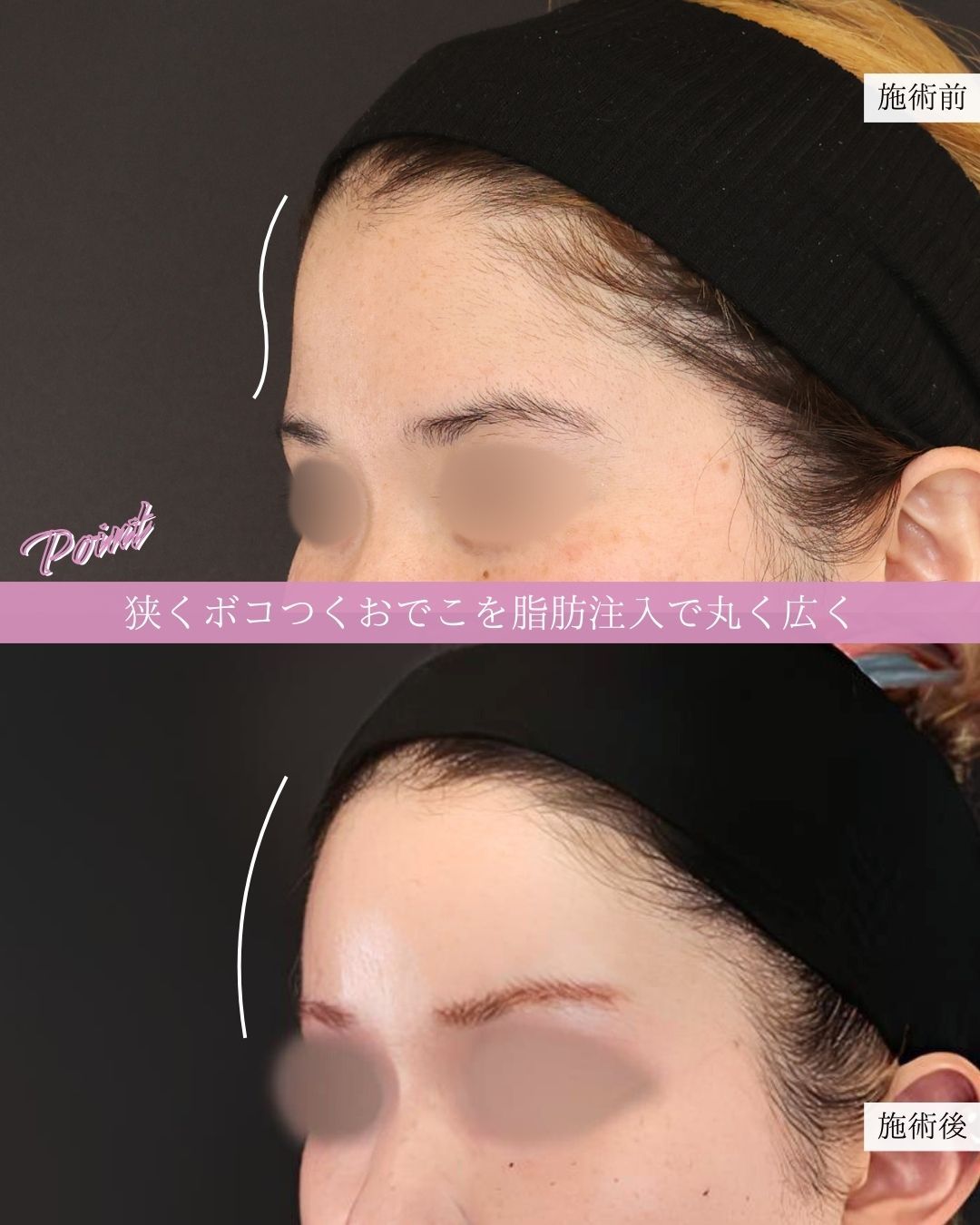 TAC式 ツヤ肌コラーゲンリフト®/Lラインファット除去（エラ下脂肪除去）/ジョールファット除去の症例写真 施術前後 