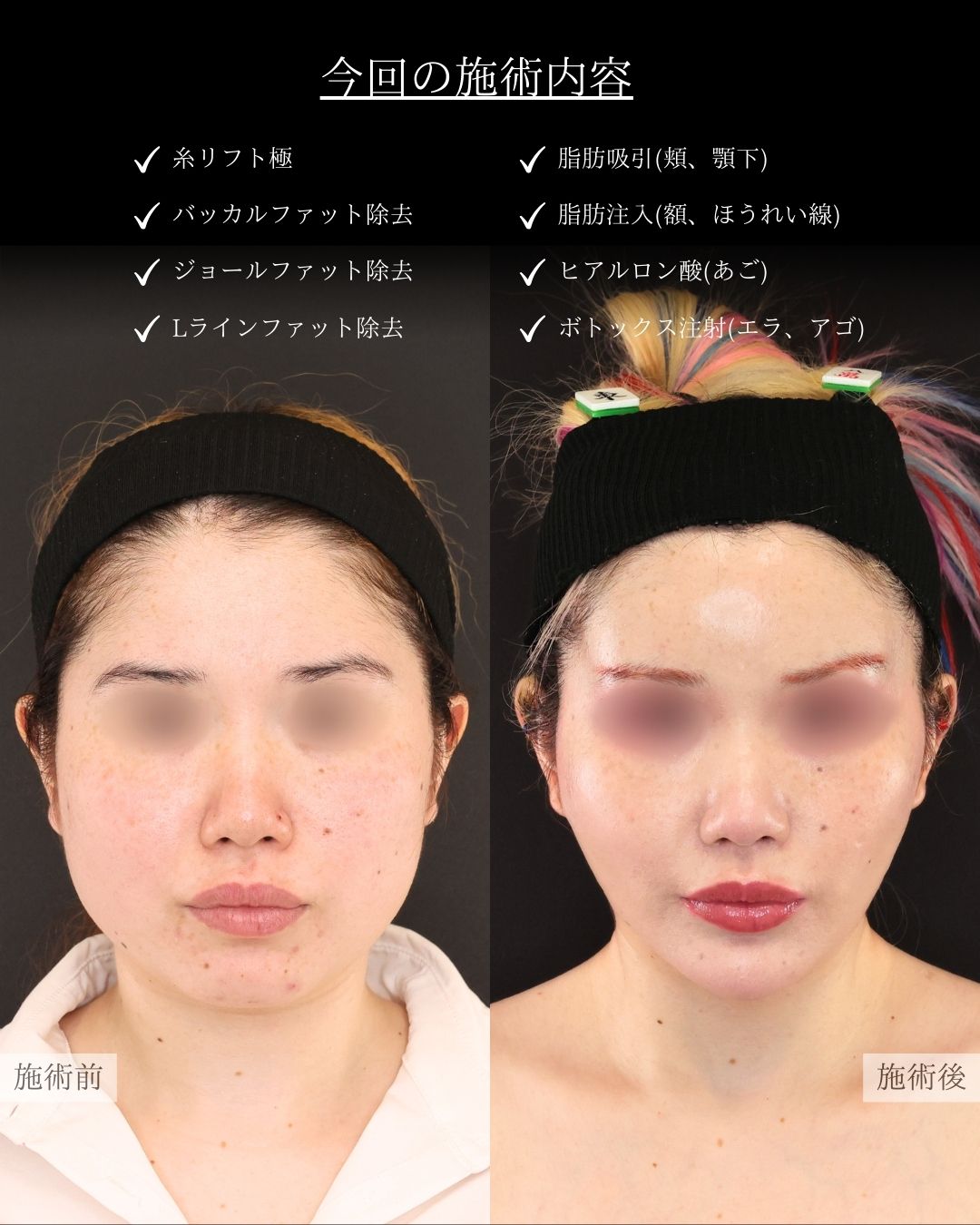 TAC式 ツヤ肌コラーゲンリフト®/Lラインファット除去（エラ下脂肪除去）/ジョールファット除去の症例写真 施術前後 