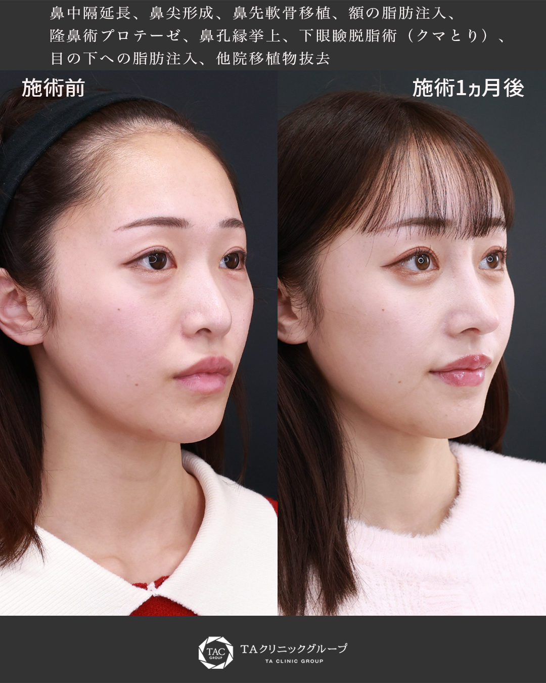 他院による鼻整形をリカバリー＆アップデート