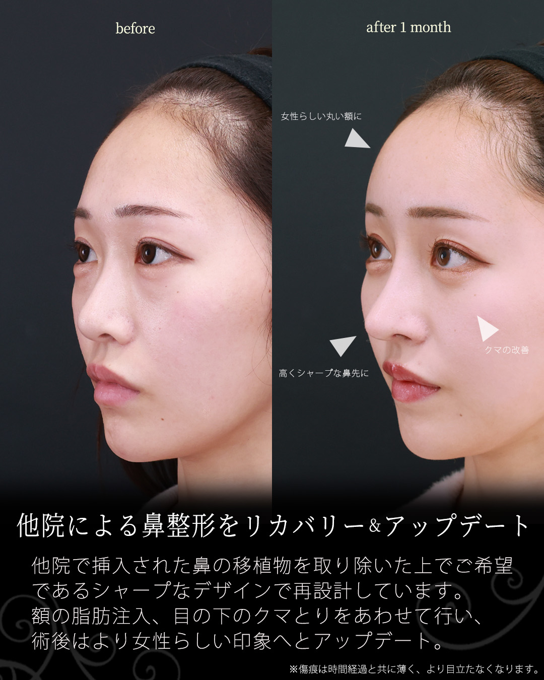 下眼瞼脱脂術（目の下のたるみ取り・目の下の脂肪ふくらみ取り）/隆鼻術（プロテーゼ・自家組織）/顔の脂肪注入(コンデンスリッチフェイス)の症例写真 施術前後 