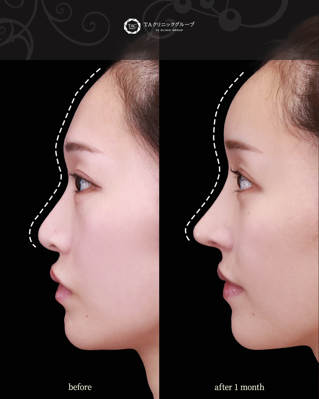 下眼瞼脱脂術（目の下のたるみ取り・目の下の脂肪ふくらみ取り）/隆鼻術（プロテーゼ・自家組織）/顔の脂肪注入(コンデンスリッチフェイス)の症例写真 施術前後 