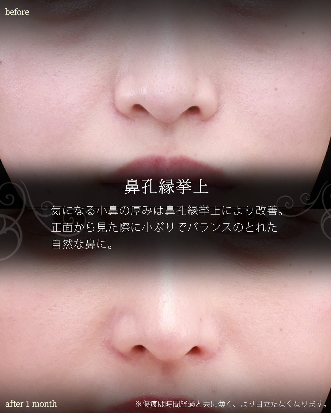 下眼瞼脱脂術（目の下のたるみ取り・目の下の脂肪ふくらみ取り）/隆鼻術（プロテーゼ・自家組織）/顔の脂肪注入(コンデンスリッチフェイス)の症例写真 施術前後 