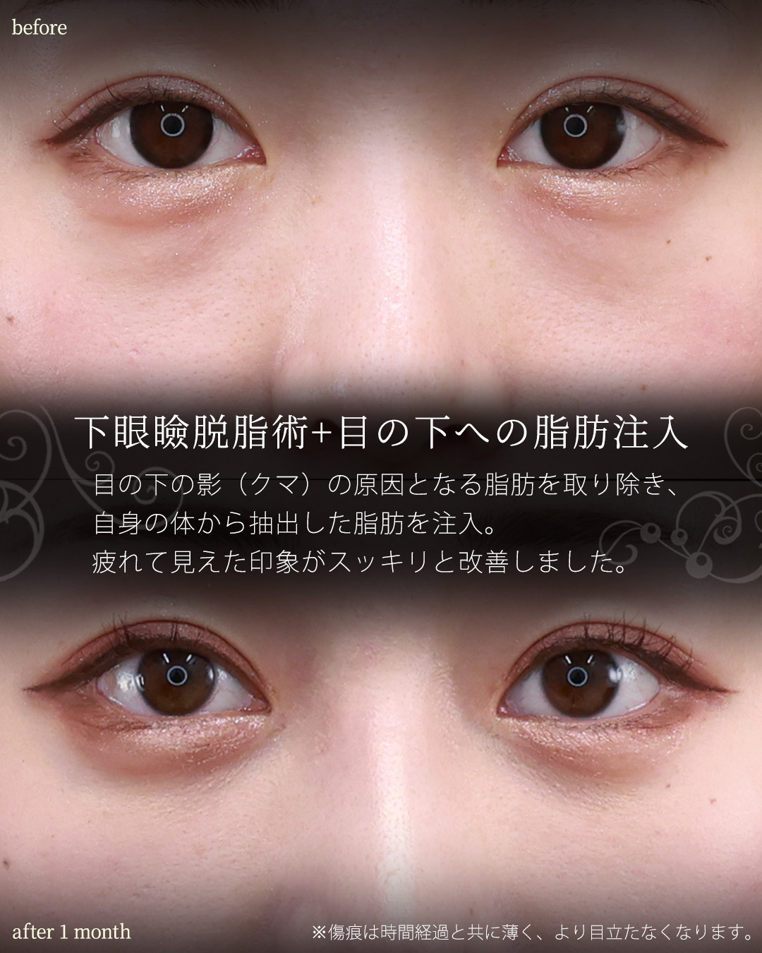 下眼瞼脱脂術（目の下のたるみ取り・目の下の脂肪ふくらみ取り）/隆鼻術（プロテーゼ・自家組織）/顔の脂肪注入(コンデンスリッチフェイス)の症例写真 施術前後 