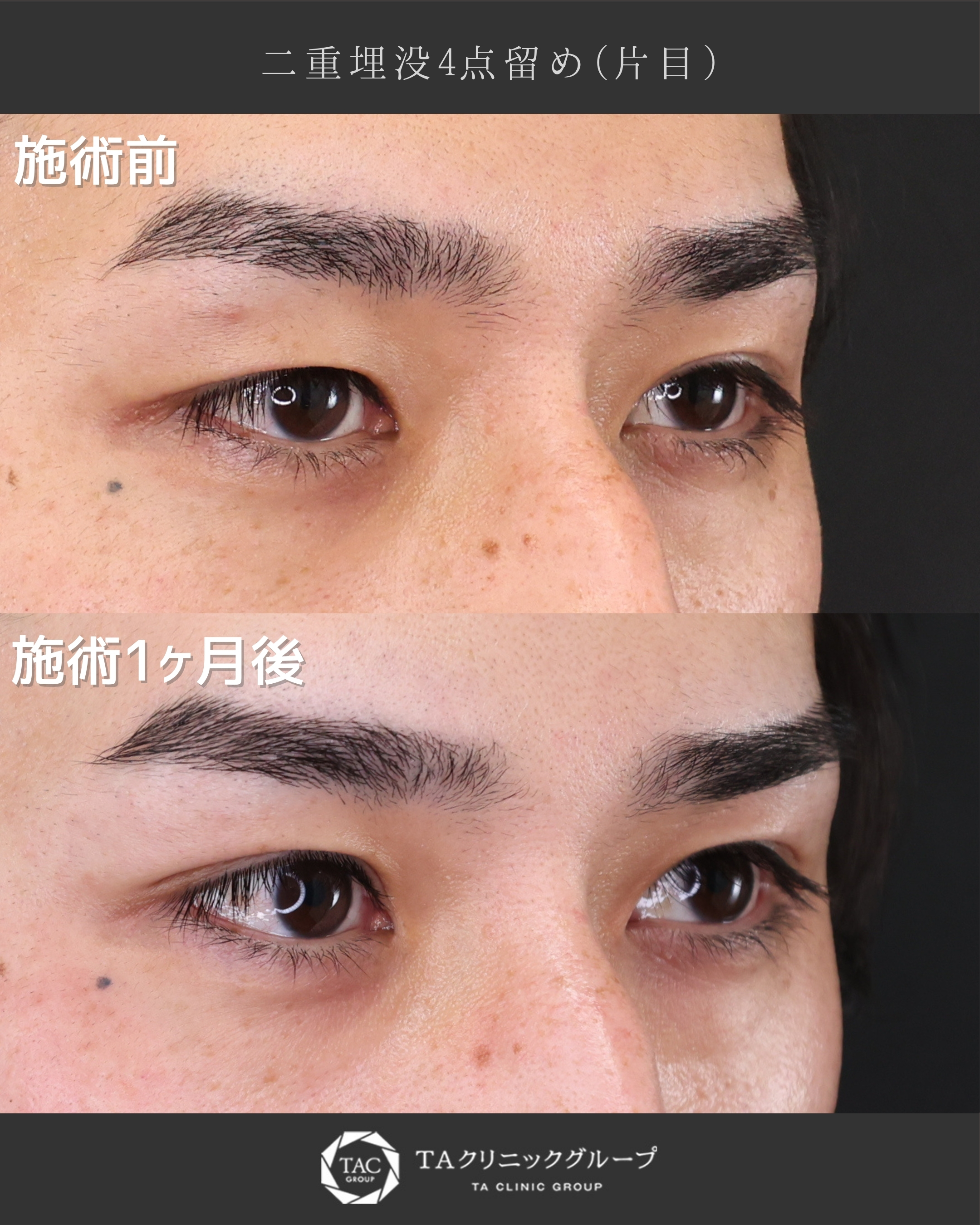 【片目埋没】で左右対称のキリッと二重に