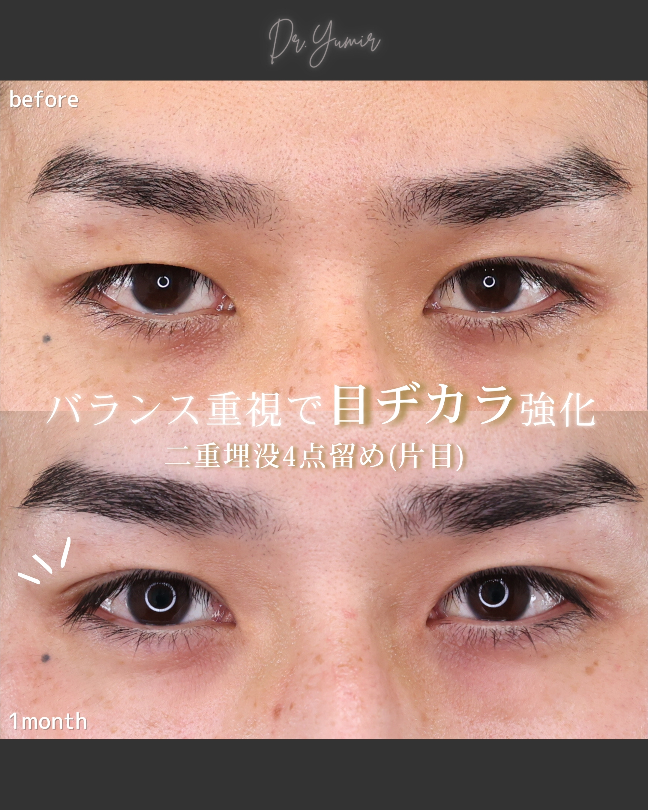 二重埋没法/片目二重術(片目だけ整形したい方)の症例写真 施術前後