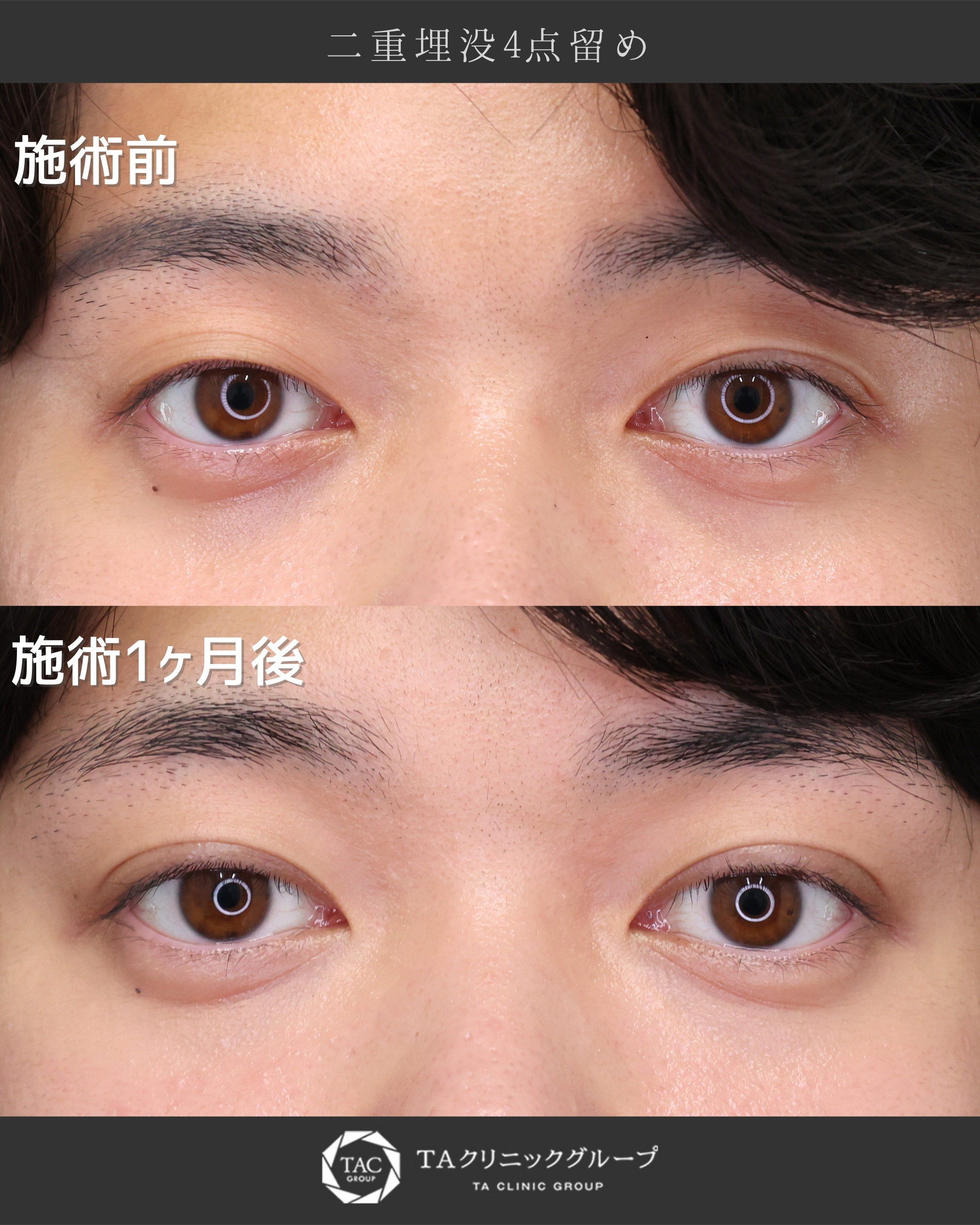 目の印象をナチュラルに変える【メンズ向き二重埋没】