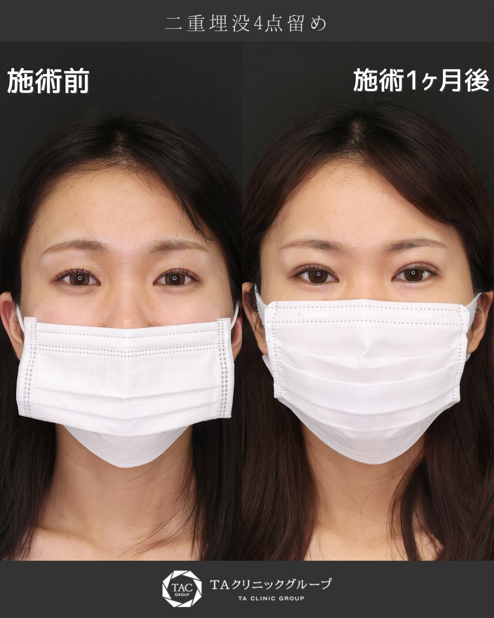 二重埋没のみで劇的変化！