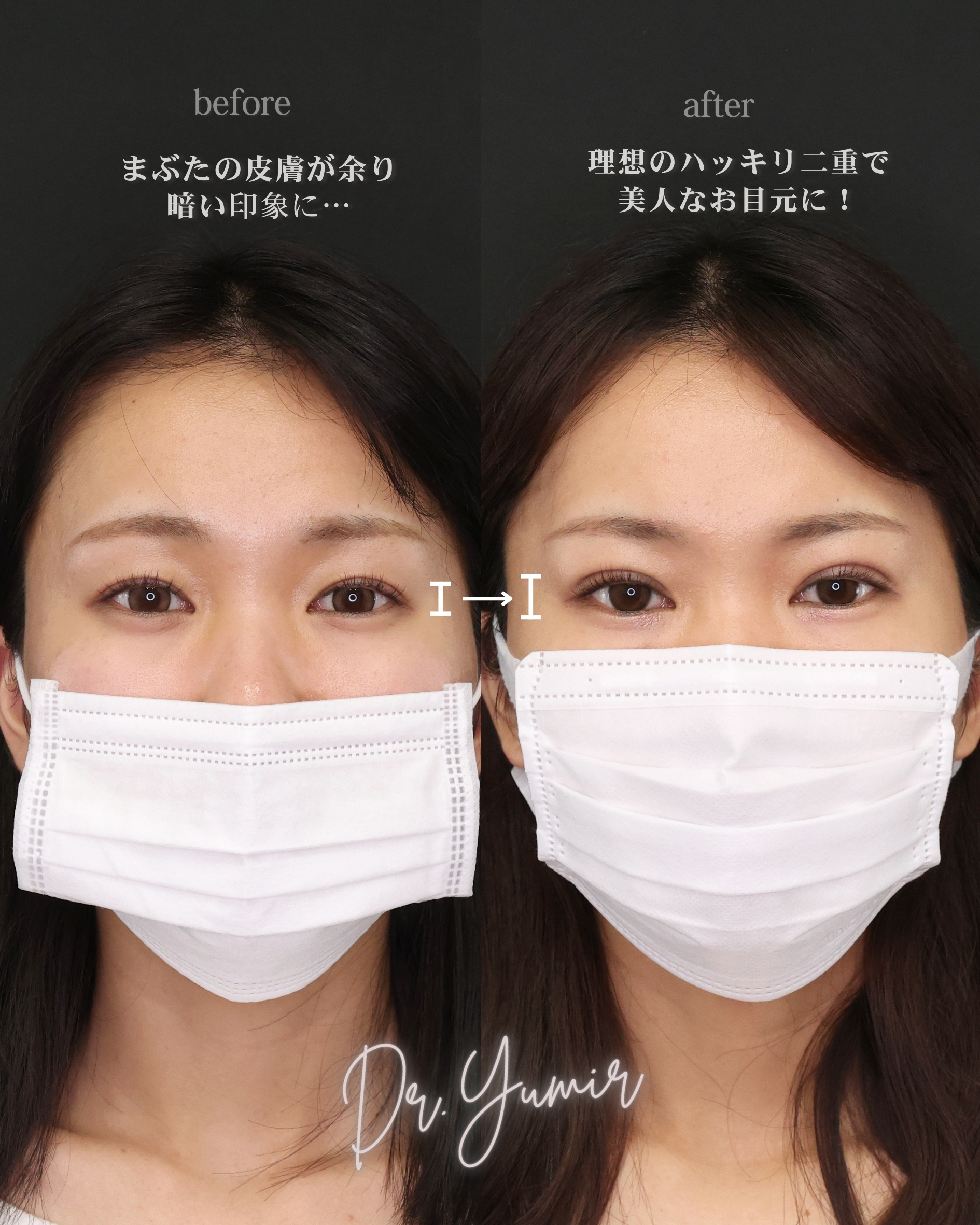 二重埋没法の症例写真 施術前後 