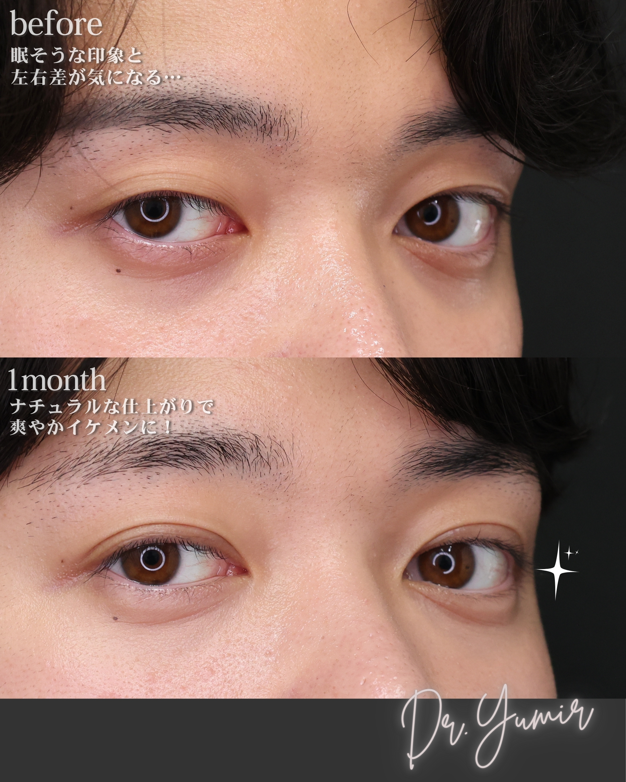 二重埋没法の症例写真 施術前後 