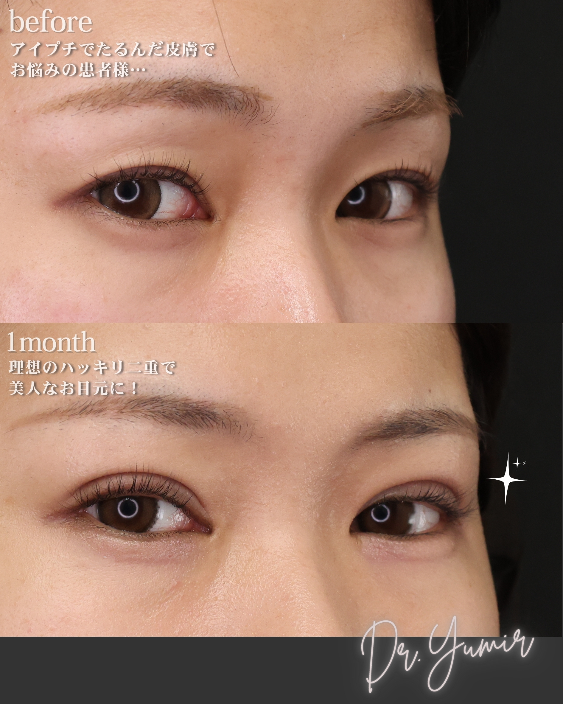 二重埋没法の症例写真 施術前後 