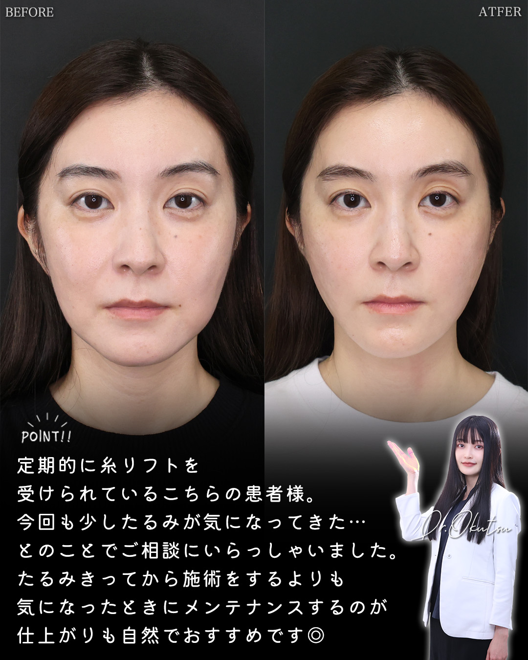 TAC式 ツヤ肌コラーゲンリフト®/TAC式 ショッピングリフト/ヒアルロン酸注射：その他の症例写真 施術前後 