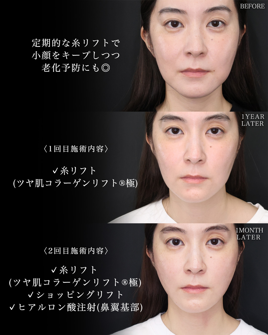 TAC式 ツヤ肌コラーゲンリフト®/TAC式 ショッピングリフト/ヒアルロン酸注射：その他の症例写真 施術前後 