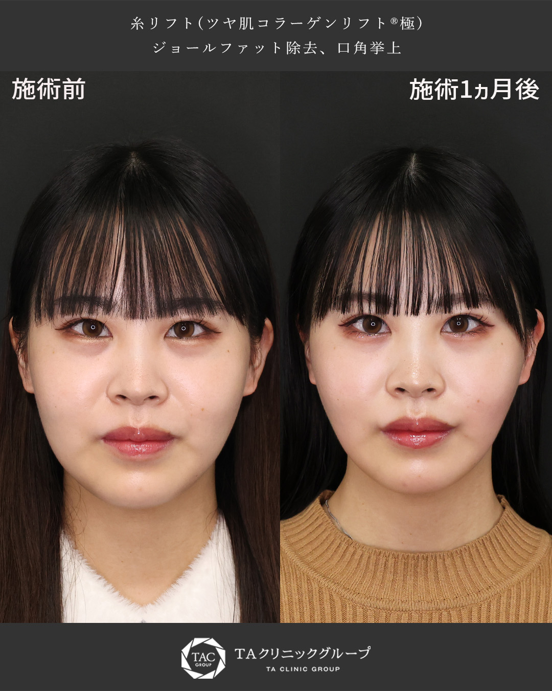 【20代症例】輪郭のもたつき・口元の影を解消◎可愛さを引き出す垢抜け整形