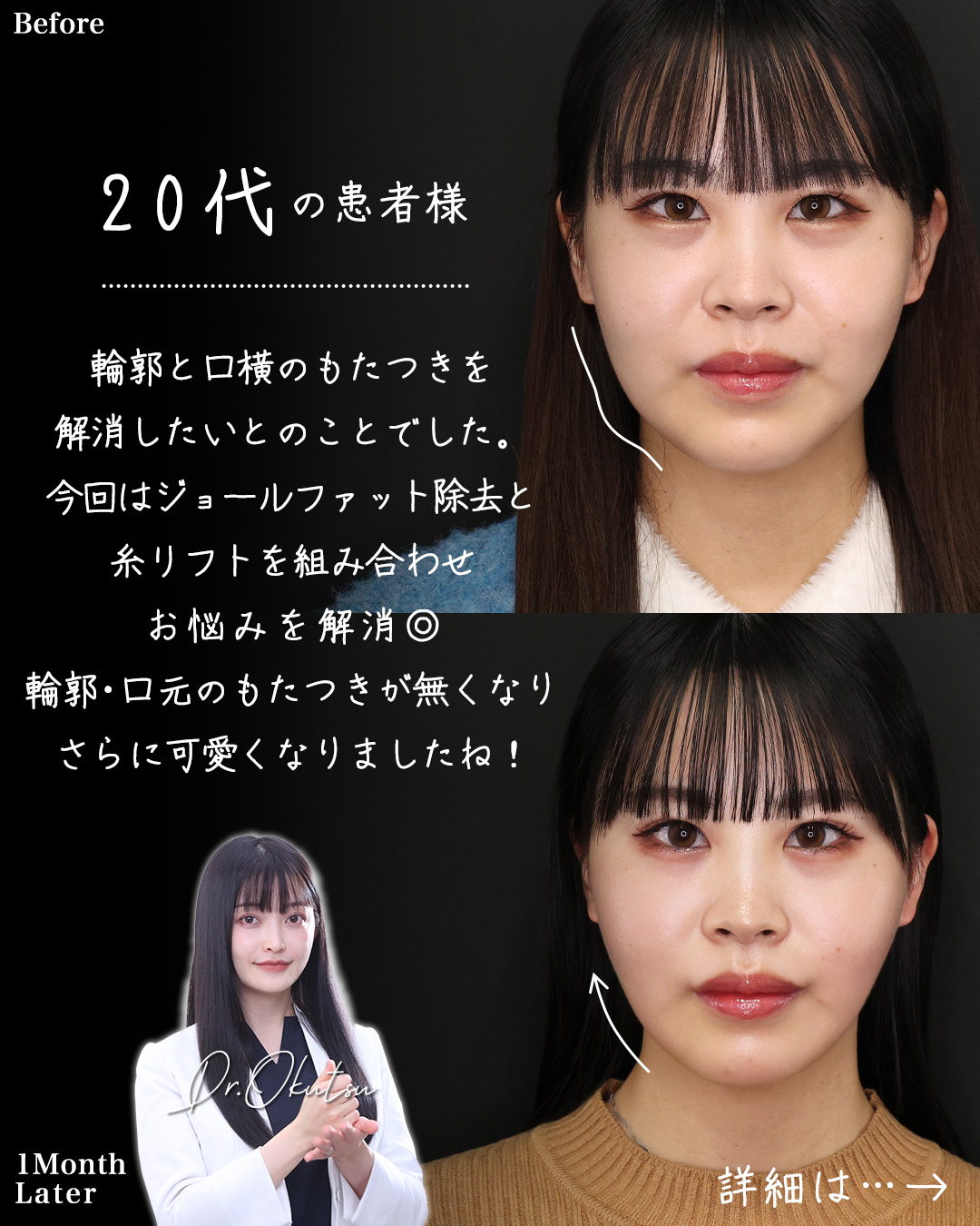 TAC式 ツヤ肌コラーゲンリフト®/ジョールファット除去/口角挙上・リフト（マイクロ切開法・内側法/口内法）の症例写真 施術前後 