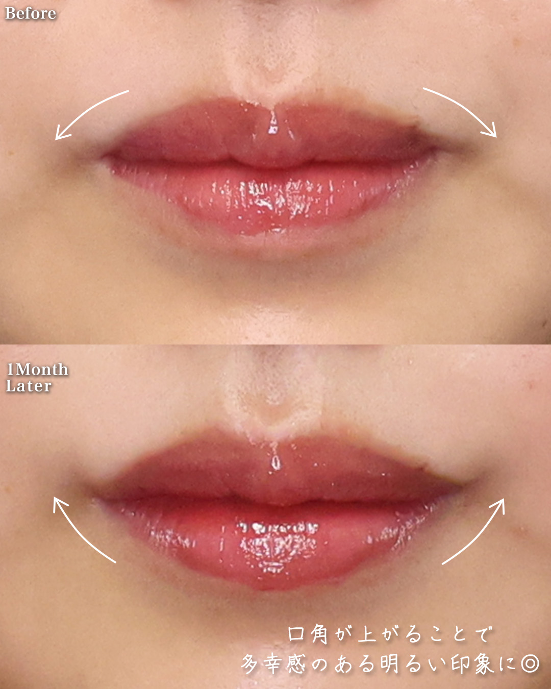 TAC式 ツヤ肌コラーゲンリフト®/ジョールファット除去/口角挙上・リフト（マイクロ切開法・内側法/口内法）の症例写真 施術前後 