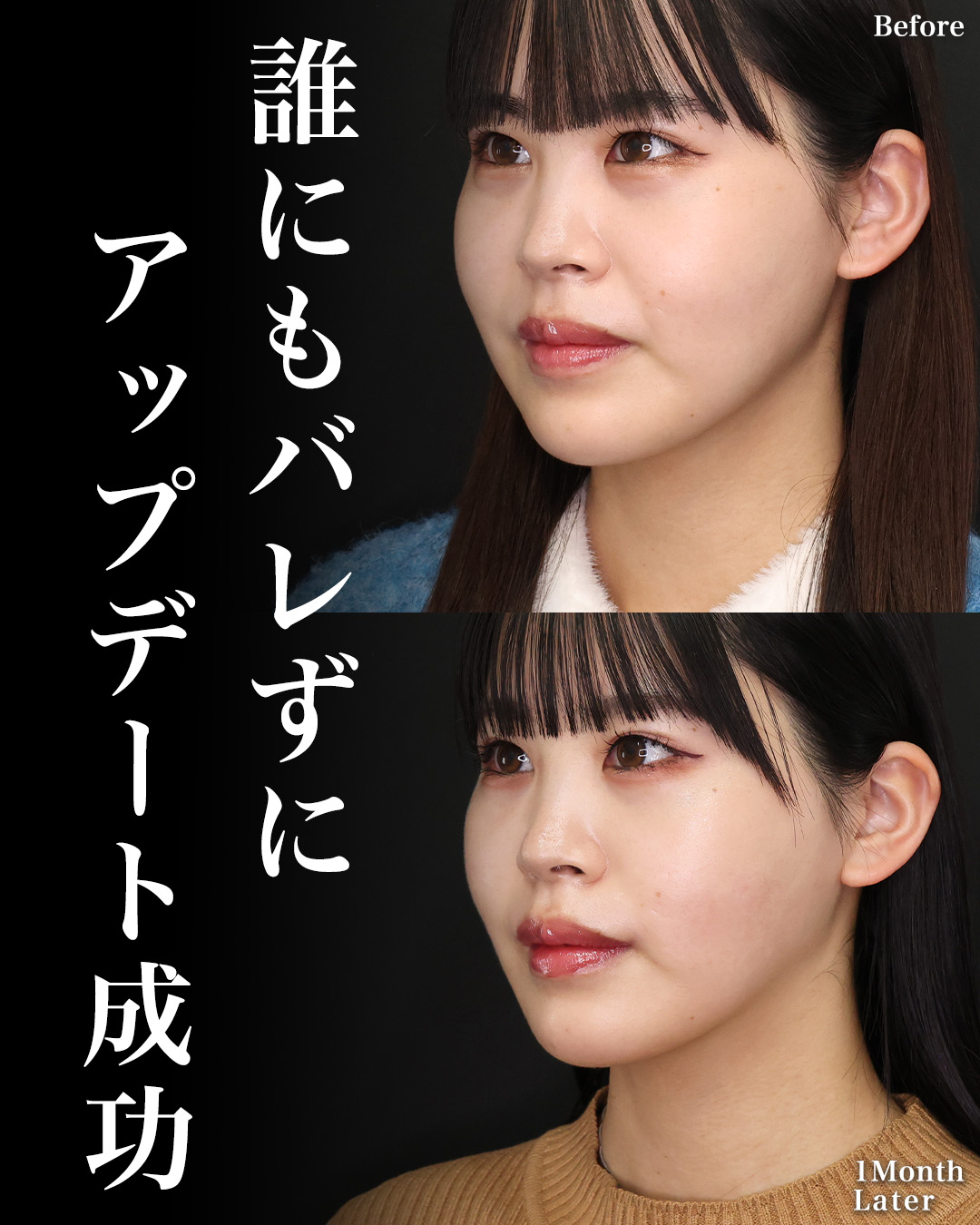 TAC式 ツヤ肌コラーゲンリフト®/ジョールファット除去/口角挙上・リフト（マイクロ切開法・内側法/口内法）の症例写真 施術前後 