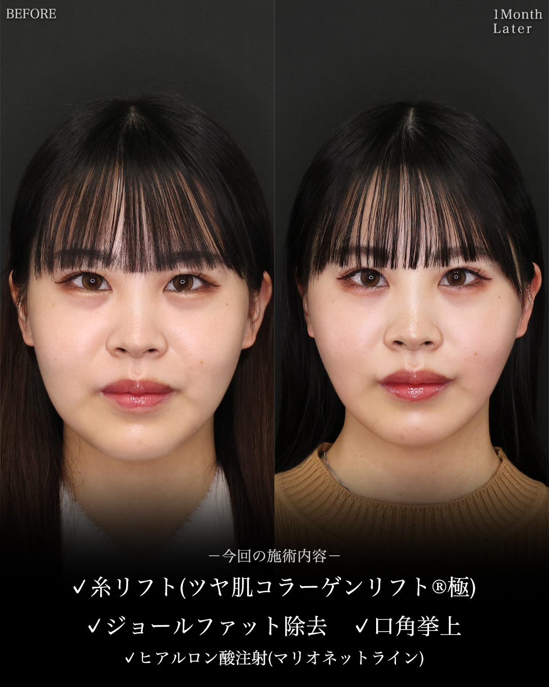 TAC式 ツヤ肌コラーゲンリフト®/ジョールファット除去/口角挙上・リフト（マイクロ切開法・内側法/口内法）の症例写真 施術前後 