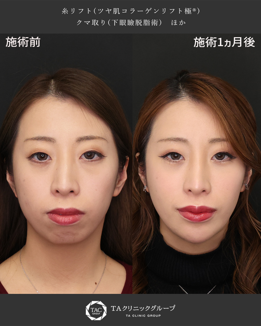 口ゴボ解消＆横顔美人に！自然な変化で若々しく垢抜け！