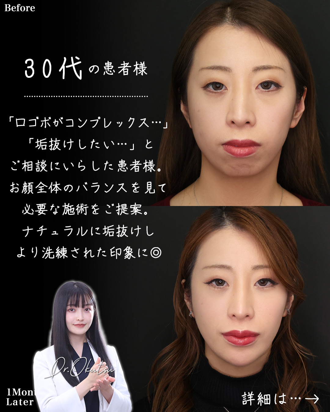 TAC式 ツヤ肌コラーゲンリフト®/下眼瞼脱脂術（目の下のたるみ取り・目の下の脂肪ふくらみ取り）/おでこ・こめかみのヒアルロン酸注射の症例写真 施術前後 