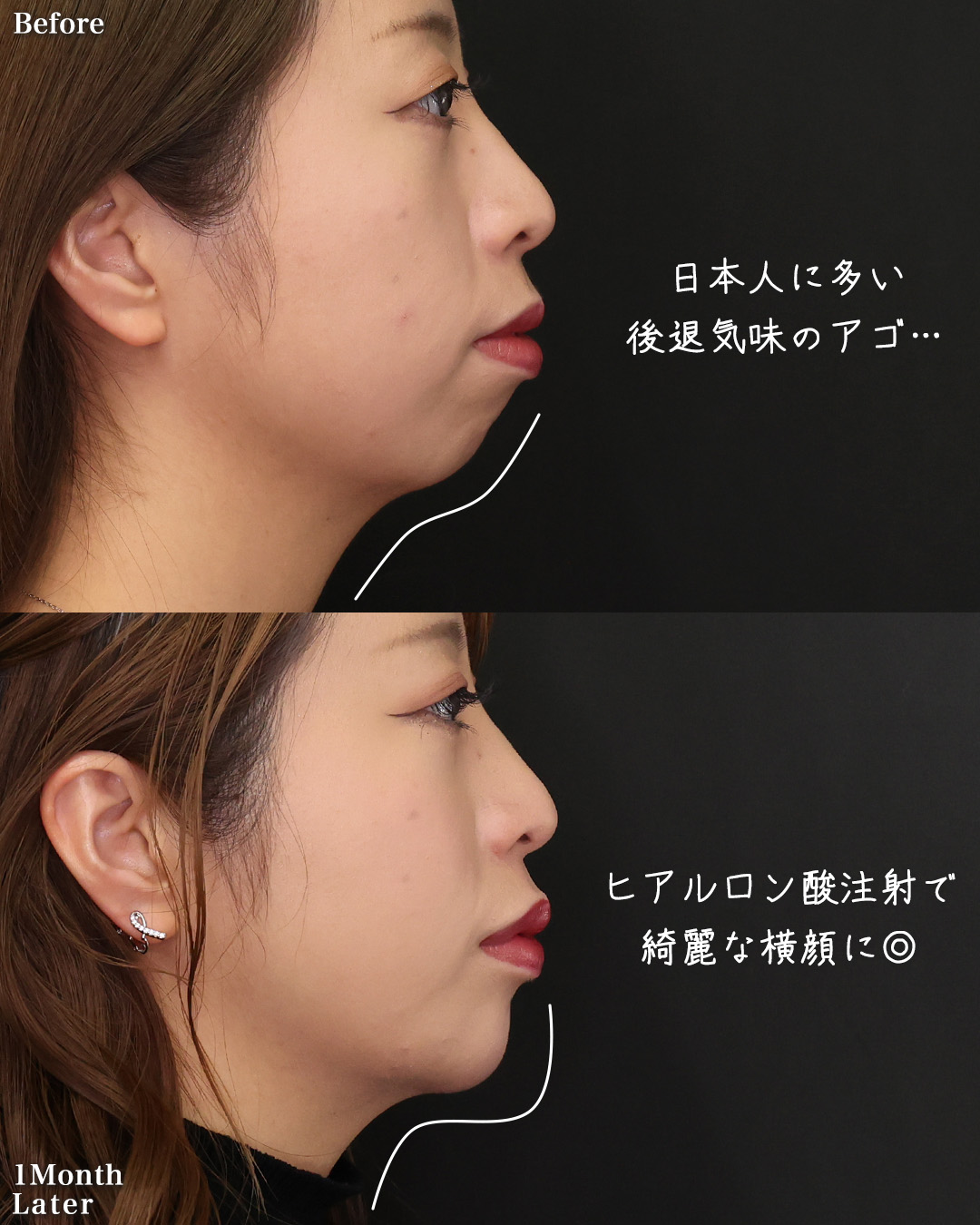 TAC式 ツヤ肌コラーゲンリフト®/下眼瞼脱脂術（目の下のたるみ取り・目の下の脂肪ふくらみ取り）/おでこ・こめかみのヒアルロン酸注射の症例写真 施術前後 