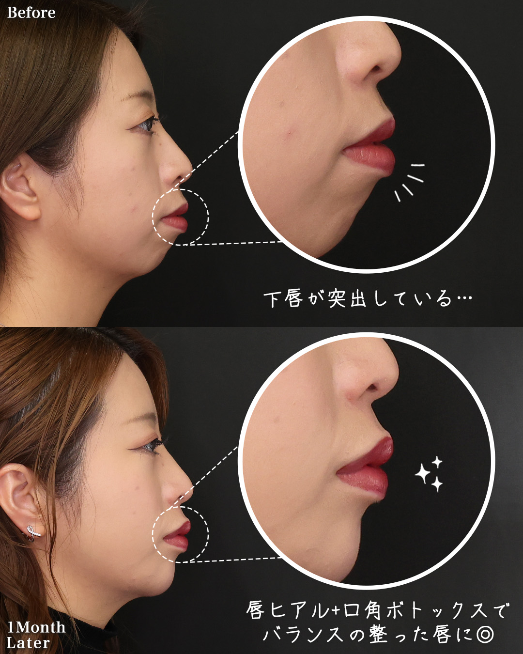 TAC式 ツヤ肌コラーゲンリフト®/下眼瞼脱脂術（目の下のたるみ取り・目の下の脂肪ふくらみ取り）/おでこ・こめかみのヒアルロン酸注射の症例写真 施術前後 