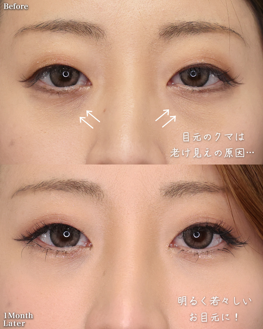 TAC式 ツヤ肌コラーゲンリフト®/下眼瞼脱脂術（目の下のたるみ取り・目の下の脂肪ふくらみ取り）/おでこ・こめかみのヒアルロン酸注射の症例写真 施術前後 