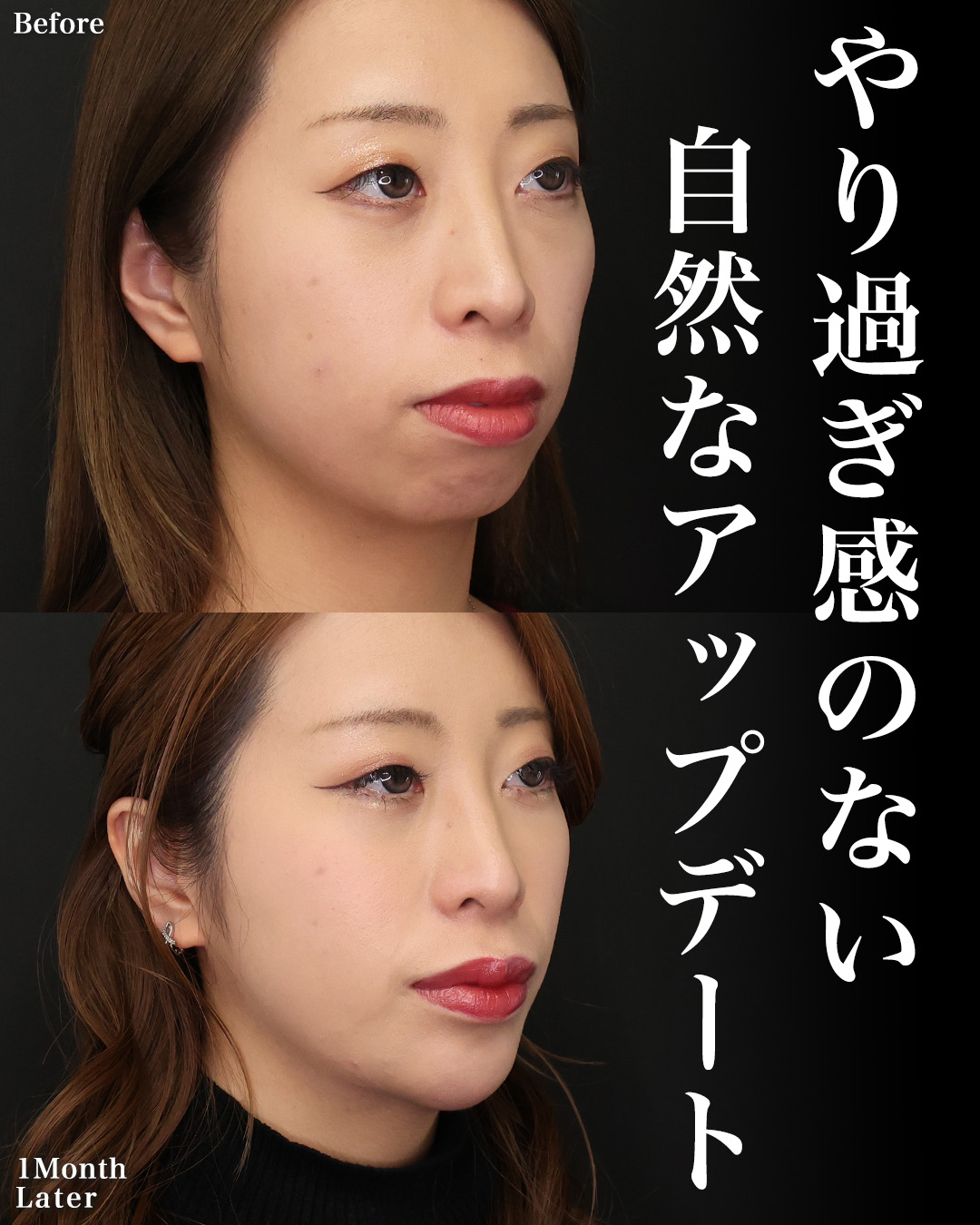 TAC式 ツヤ肌コラーゲンリフト®/下眼瞼脱脂術（目の下のたるみ取り・目の下の脂肪ふくらみ取り）/おでこ・こめかみのヒアルロン酸注射の症例写真 施術前後 