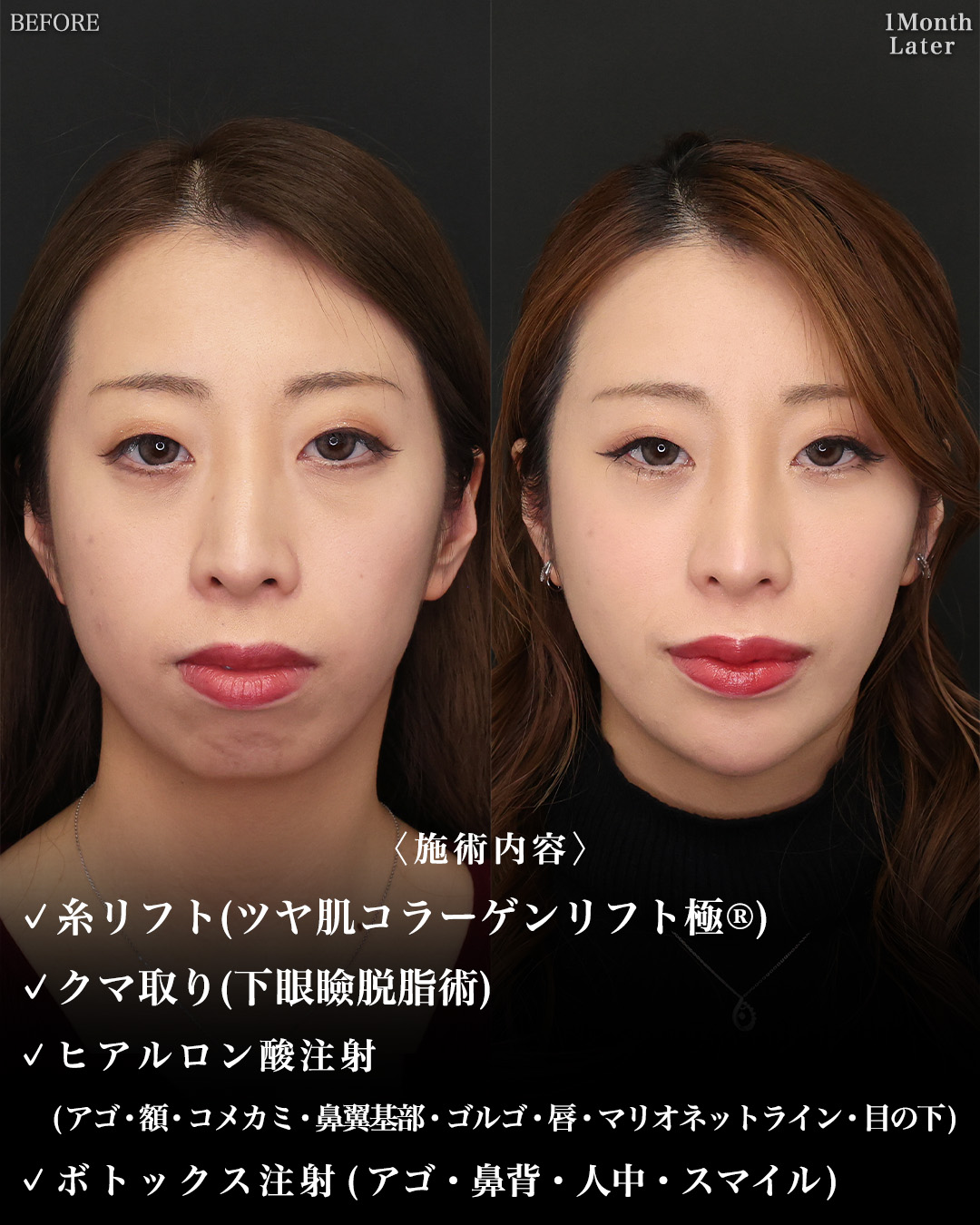 TAC式 ツヤ肌コラーゲンリフト®/下眼瞼脱脂術（目の下のたるみ取り・目の下の脂肪ふくらみ取り）/おでこ・こめかみのヒアルロン酸注射の症例写真 施術前後 