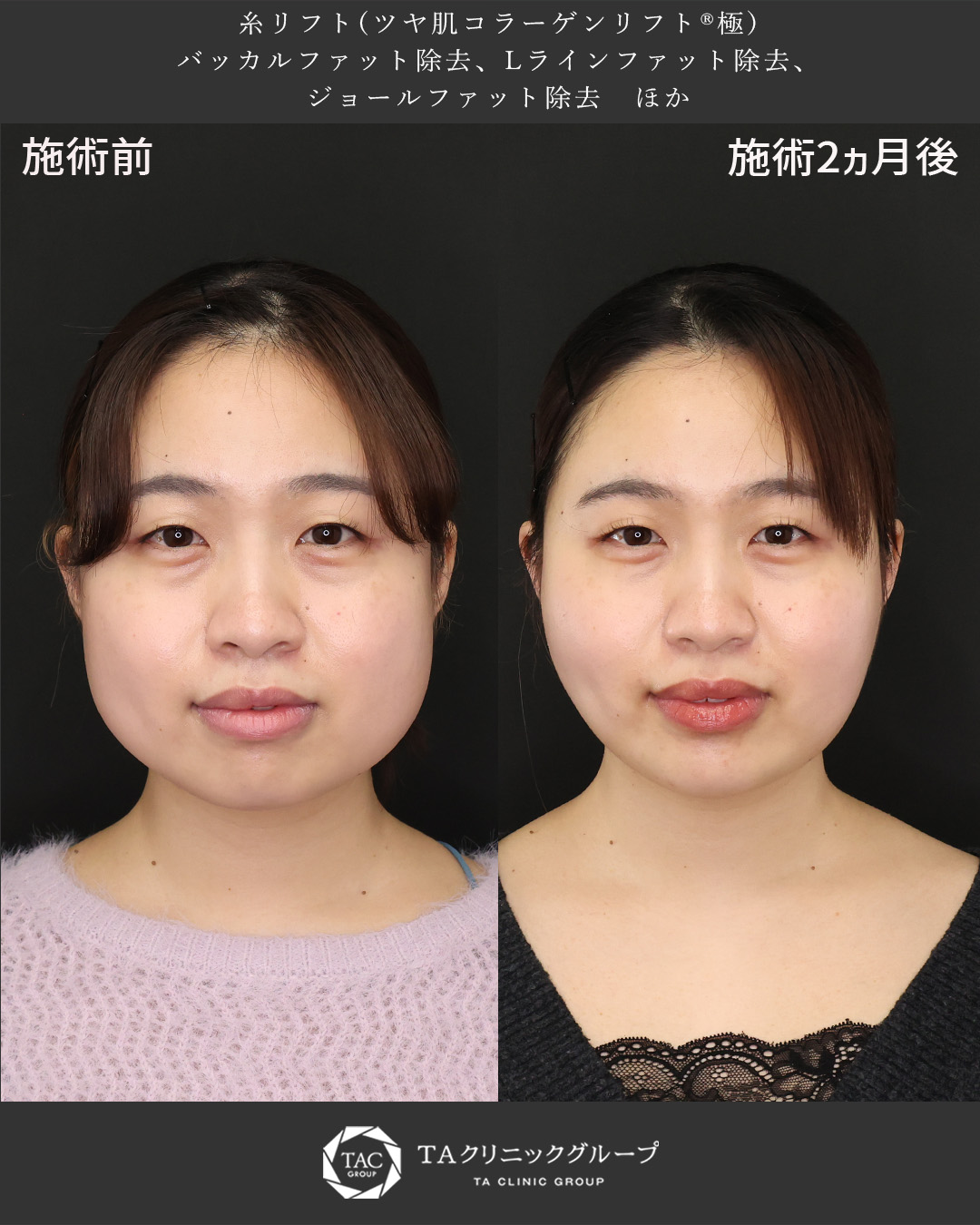 【20代小顔整形】下膨れ感解消で笑顔もスッキリ！糸リフト×脂肪除去