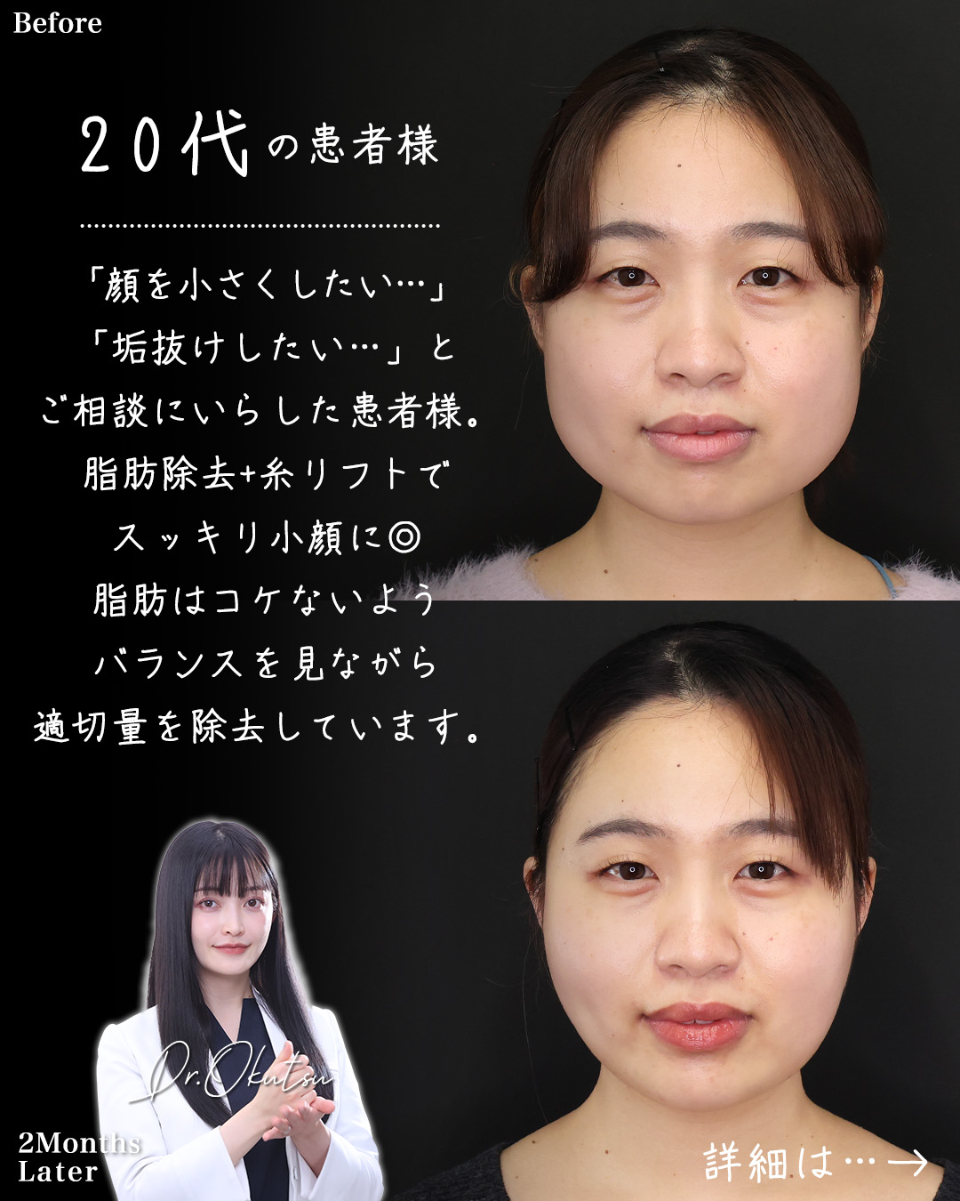 TAC式 ツヤ肌コラーゲンリフト®/バッカルファット除去/ジョールファット除去の症例写真 施術前後 