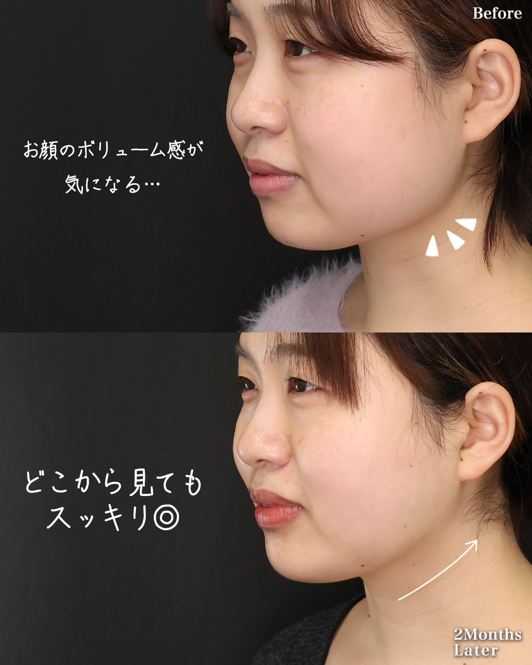 TAC式 ツヤ肌コラーゲンリフト®/バッカルファット除去/ジョールファット除去の症例写真 施術前後 