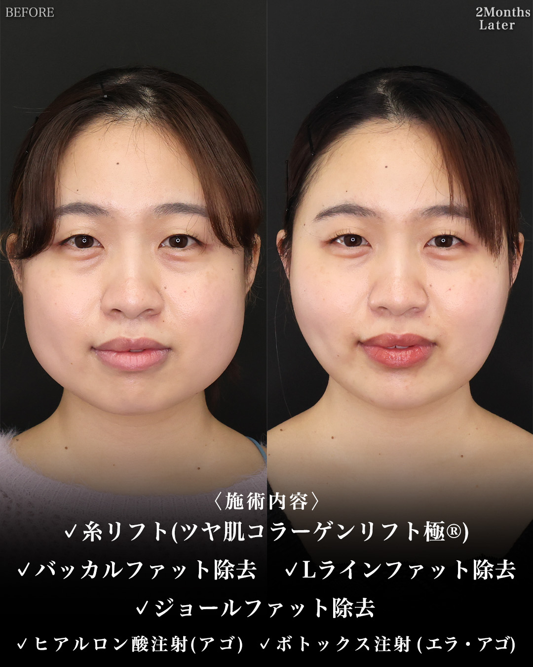 TAC式 ツヤ肌コラーゲンリフト®/バッカルファット除去/ジョールファット除去の症例写真 施術前後 