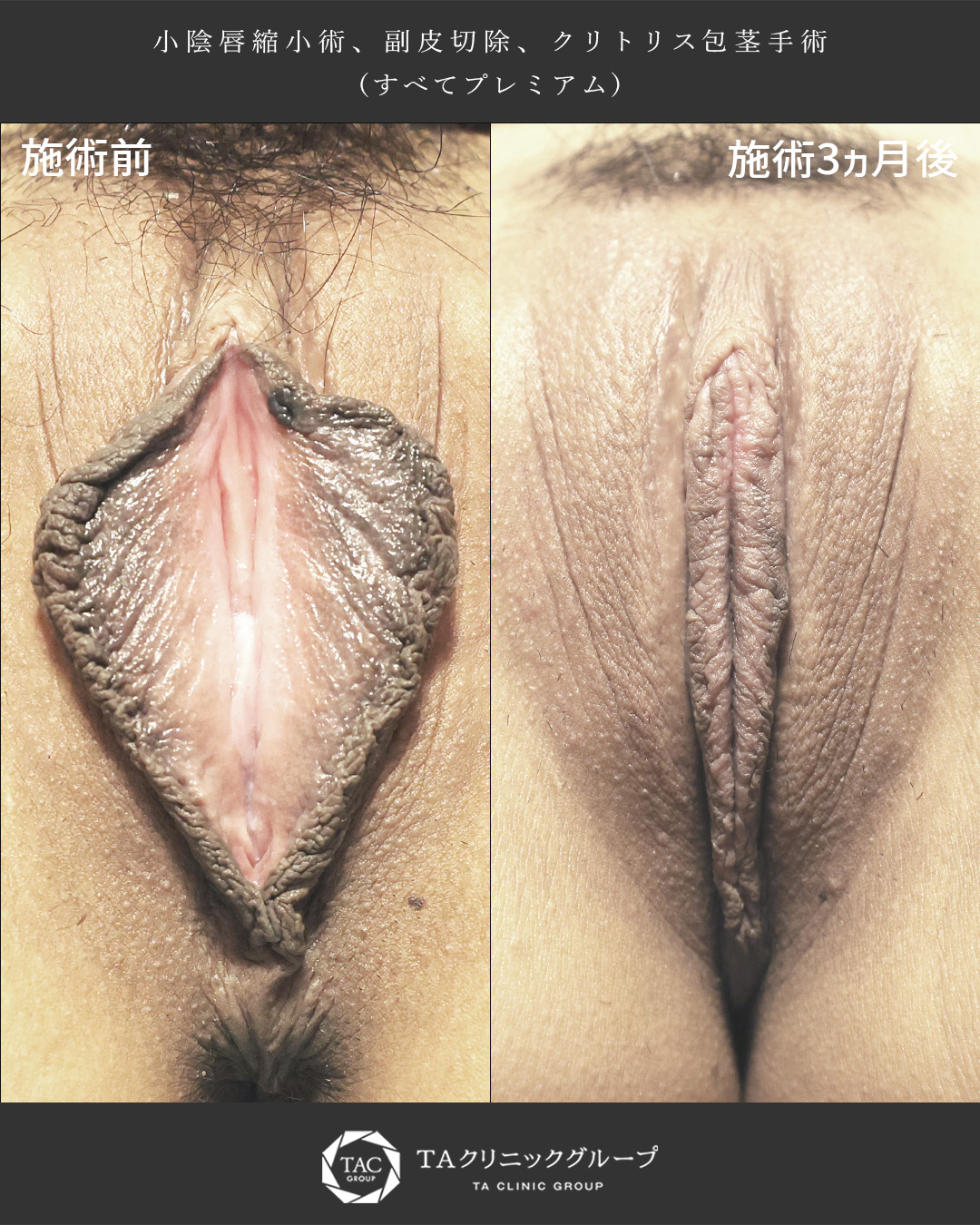 【女性器形成】大きさ・お痛み・衛生面すべて解消