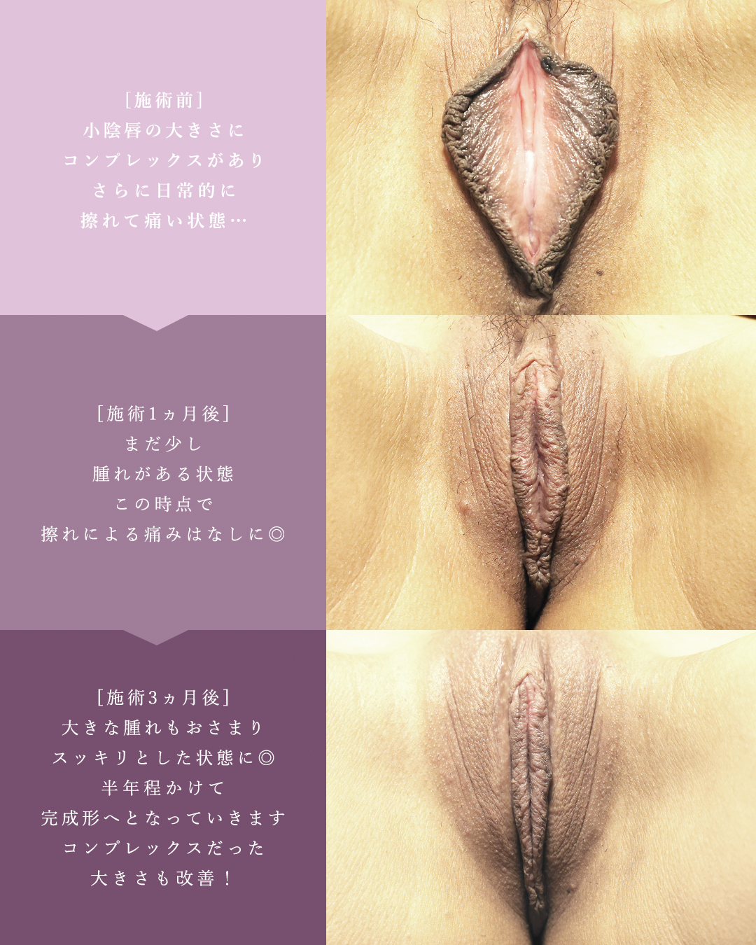 TAC式小陰唇縮小術（ヴィーナスシルエット）/副皮切除/クリトリス包茎手術の症例写真 施術前後 
