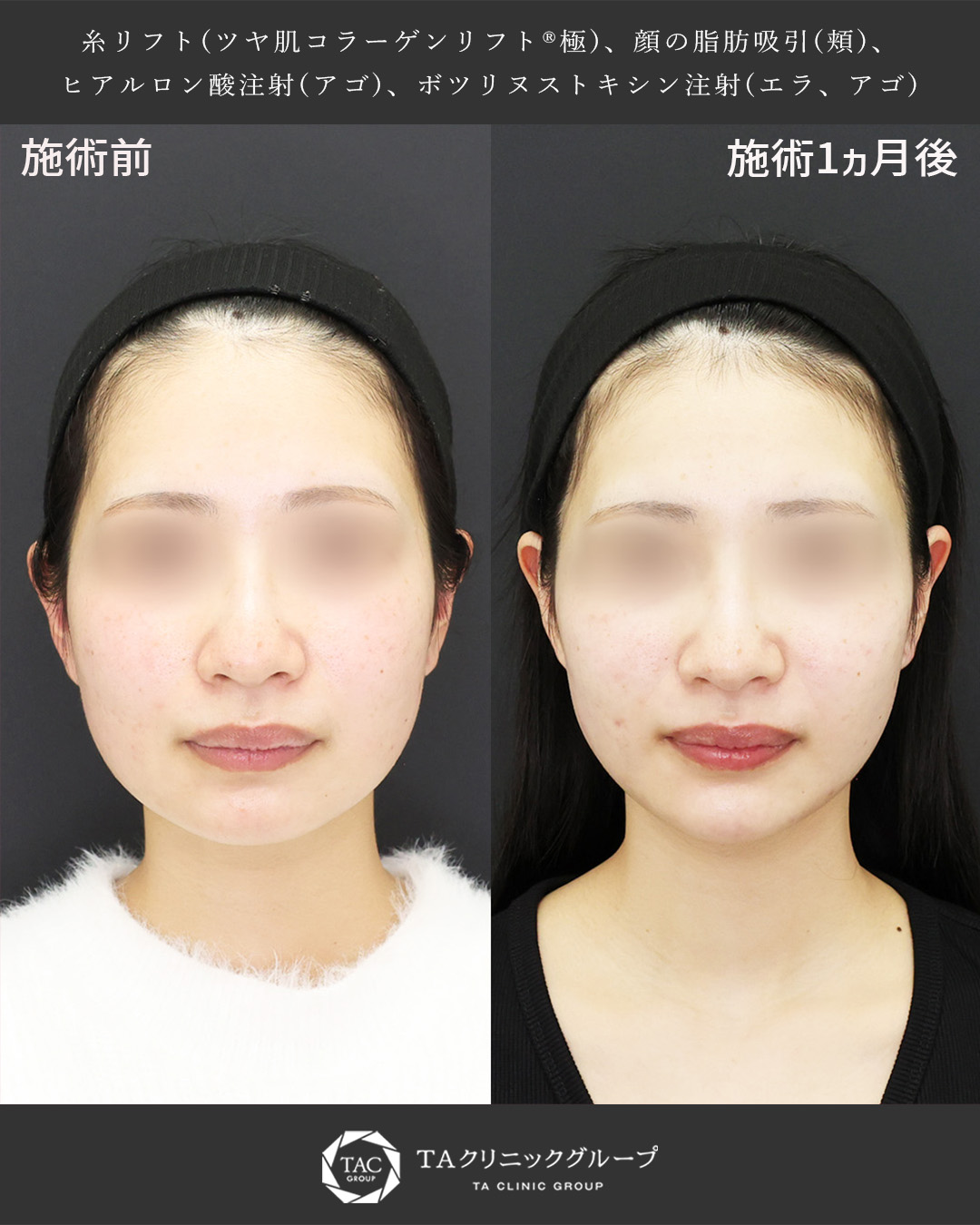 頬のもたつきをリセット│糸リフト×脂肪吸引で垢抜け
