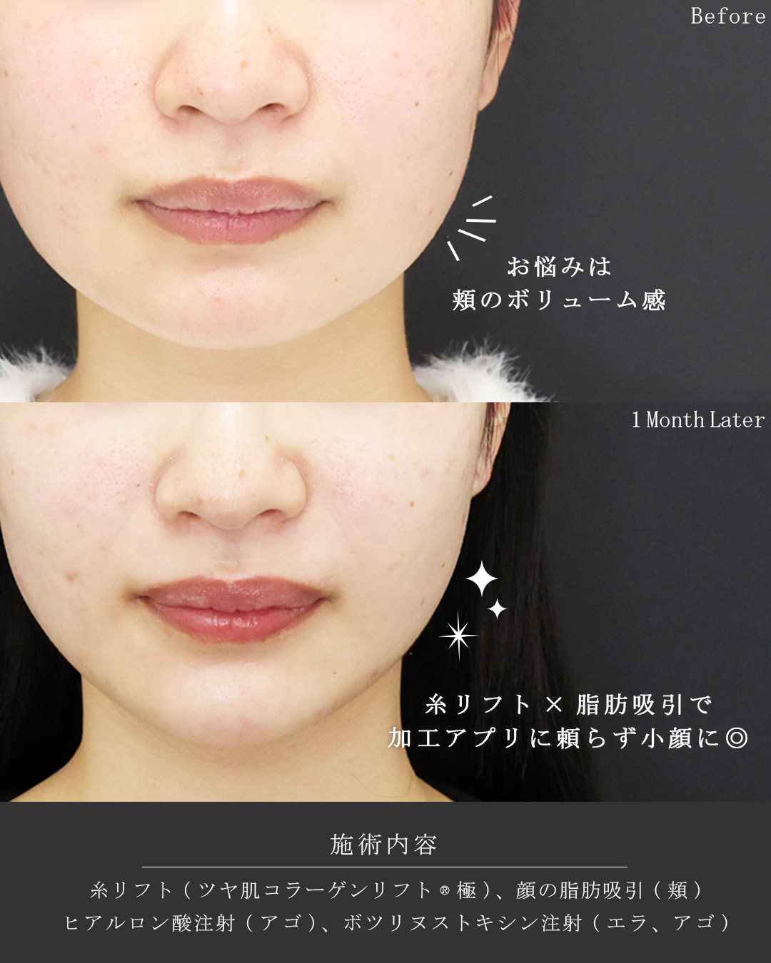 TAC式 ツヤ肌コラーゲンリフト®/顔の脂肪吸引/顎のヒアルロン酸注射の症例写真 施術前後 