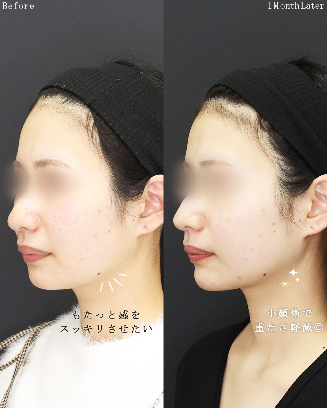 TAC式 ツヤ肌コラーゲンリフト®/顔の脂肪吸引/顎のヒアルロン酸注射の症例写真 施術前後 