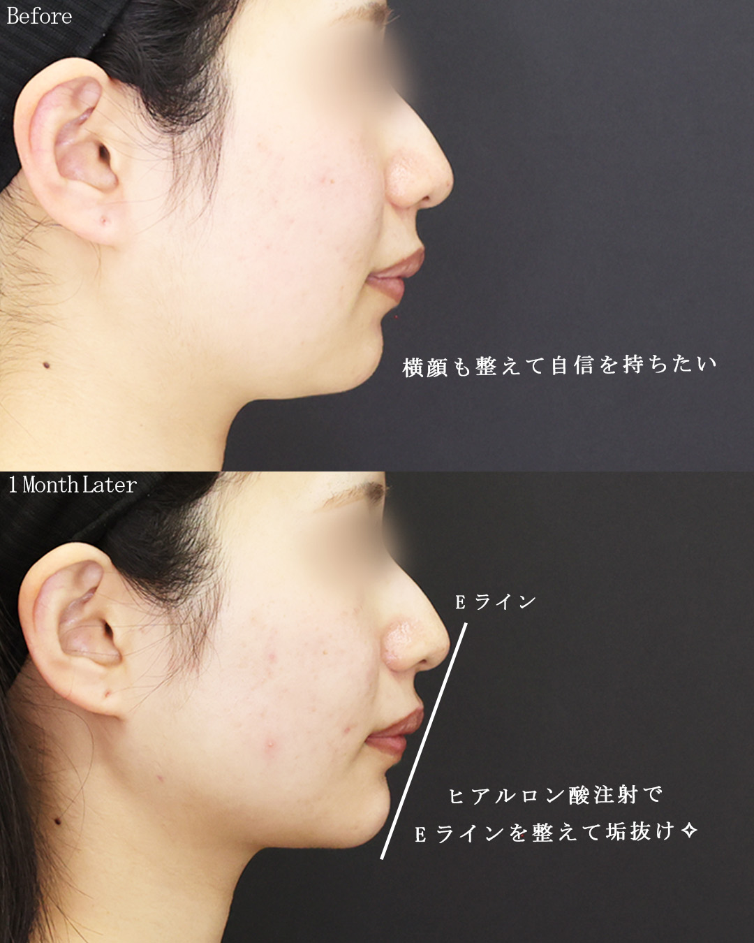 TAC式 ツヤ肌コラーゲンリフト®/顔の脂肪吸引/顎のヒアルロン酸注射の症例写真 施術前後 