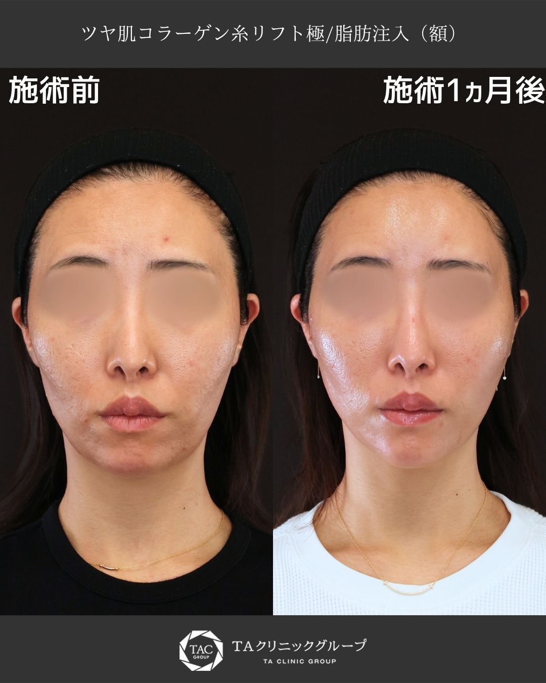 【形成外科専門医執刀】糸リフト×脂肪注入で、ツヤとハリのある若々しいお肌へ