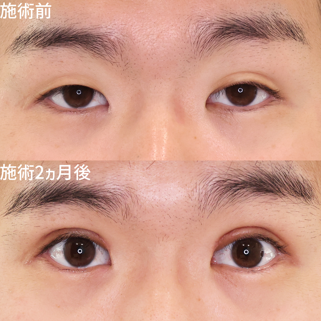 【メンズ二重】挙筋腱膜前転術で優しい目元に