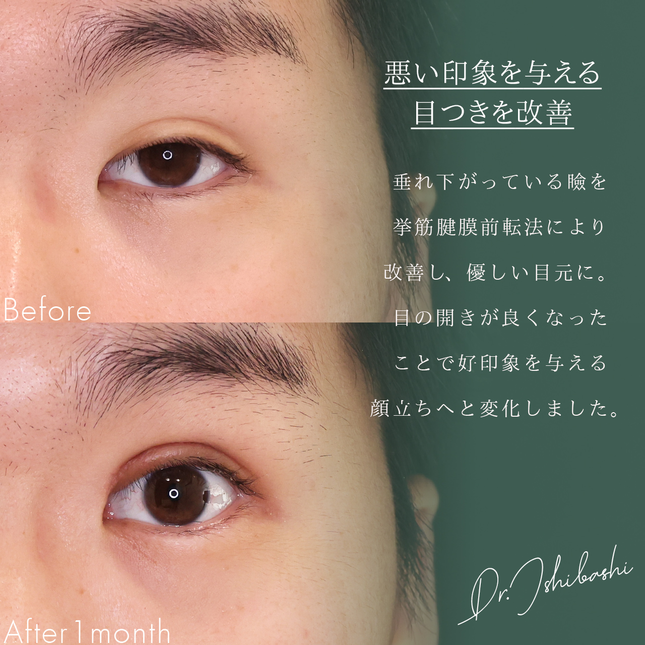 眼瞼下垂（目つき矯正）/二重切開（全切開法）の症例写真 施術前後 