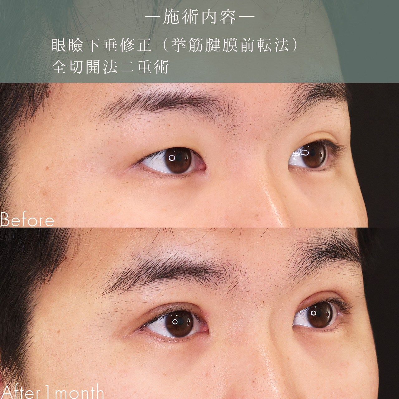 眼瞼下垂（目つき矯正）/二重切開（全切開法）の症例写真 施術前後 