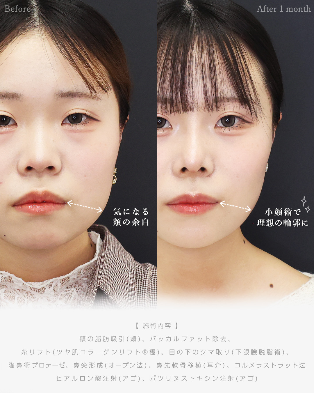 顔の脂肪吸引/バッカルファット除去/TAC式 ツヤ肌コラーゲンリフト®の症例写真 施術前後