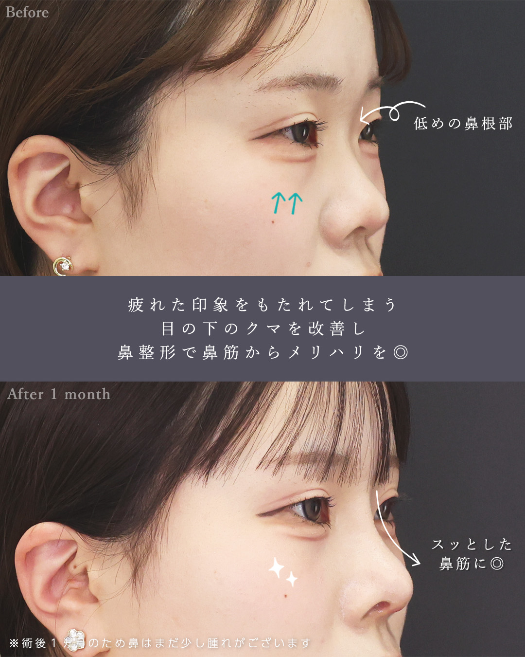 顔の脂肪吸引/バッカルファット除去/TAC式 ツヤ肌コラーゲンリフト®の症例写真 施術前後